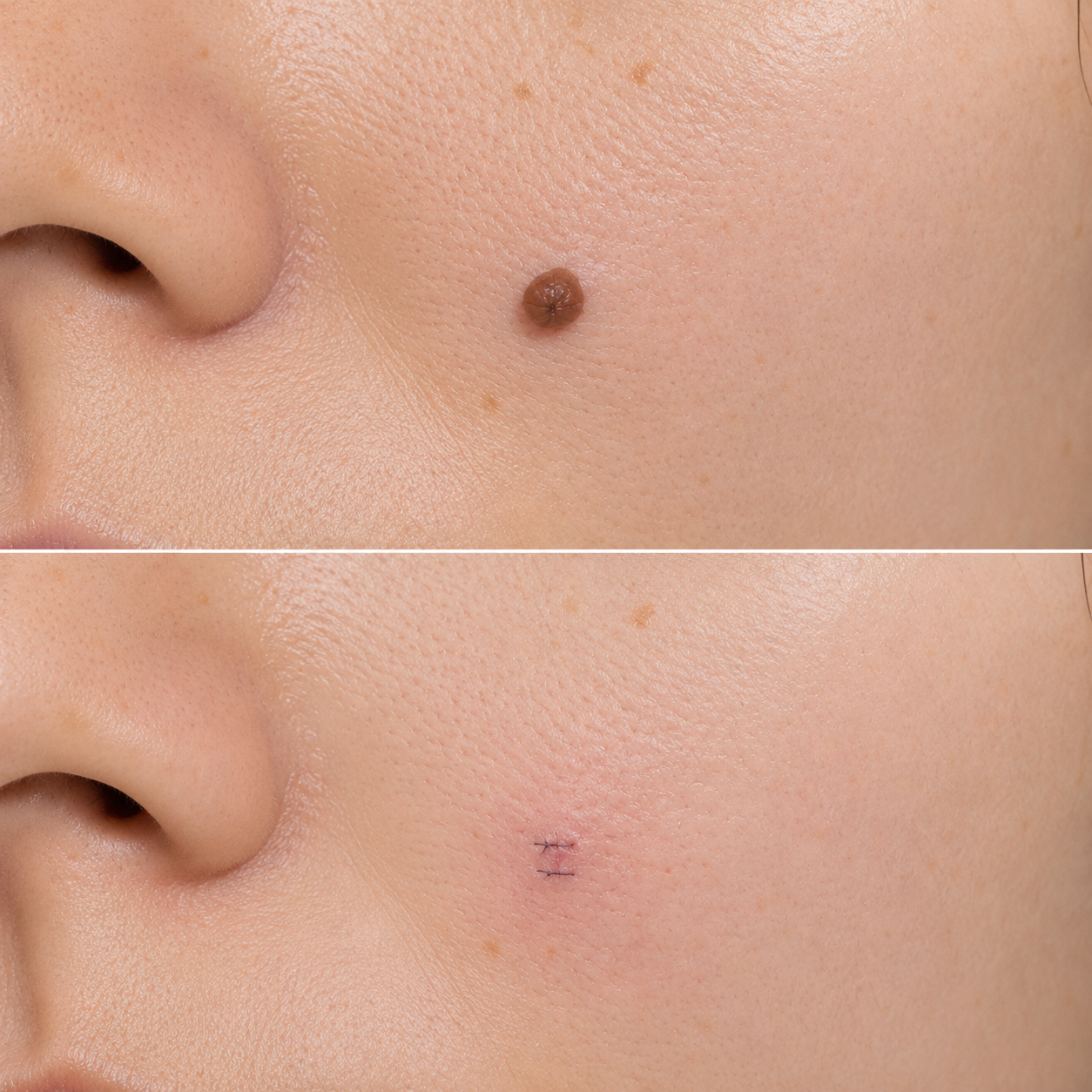 Before and after mole removal result 3