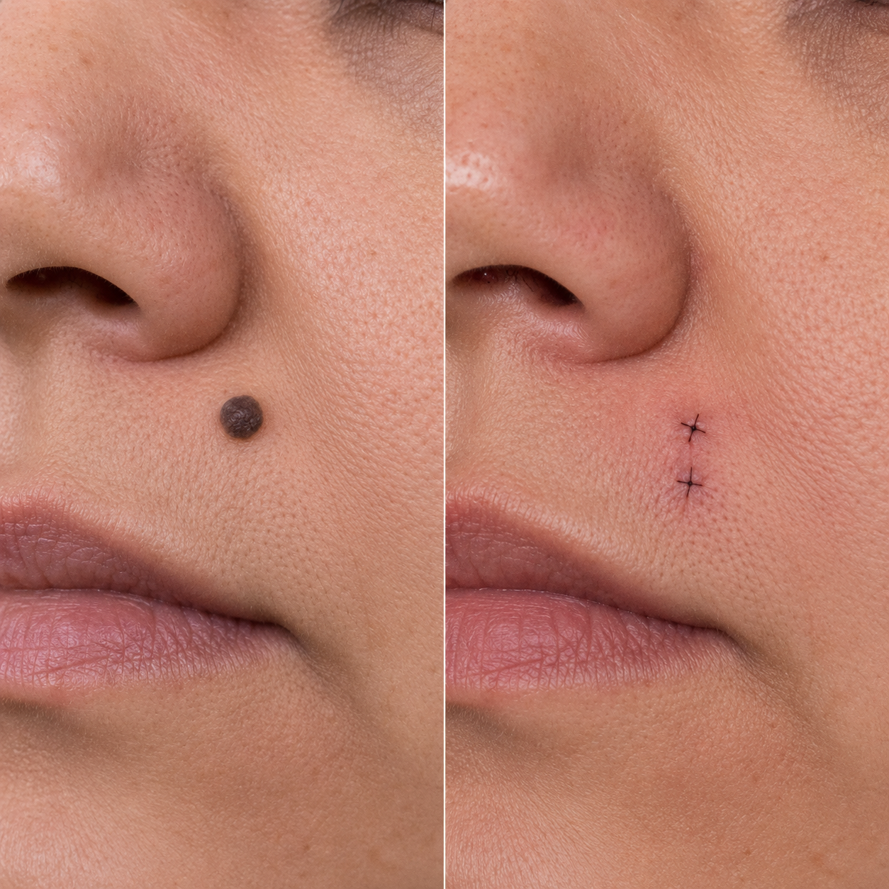 Before and after mole removal result 5