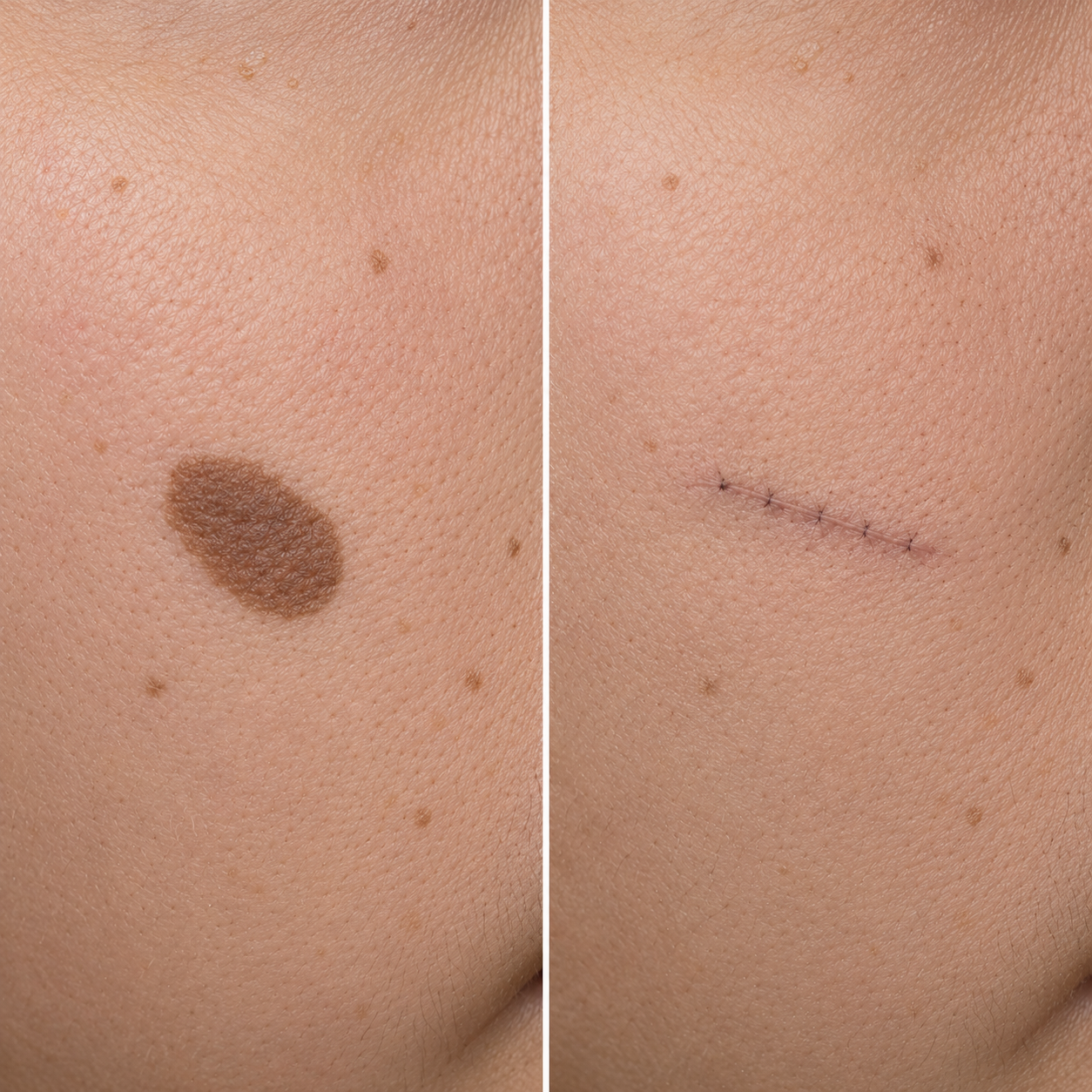Elliptical Excision result, before and after