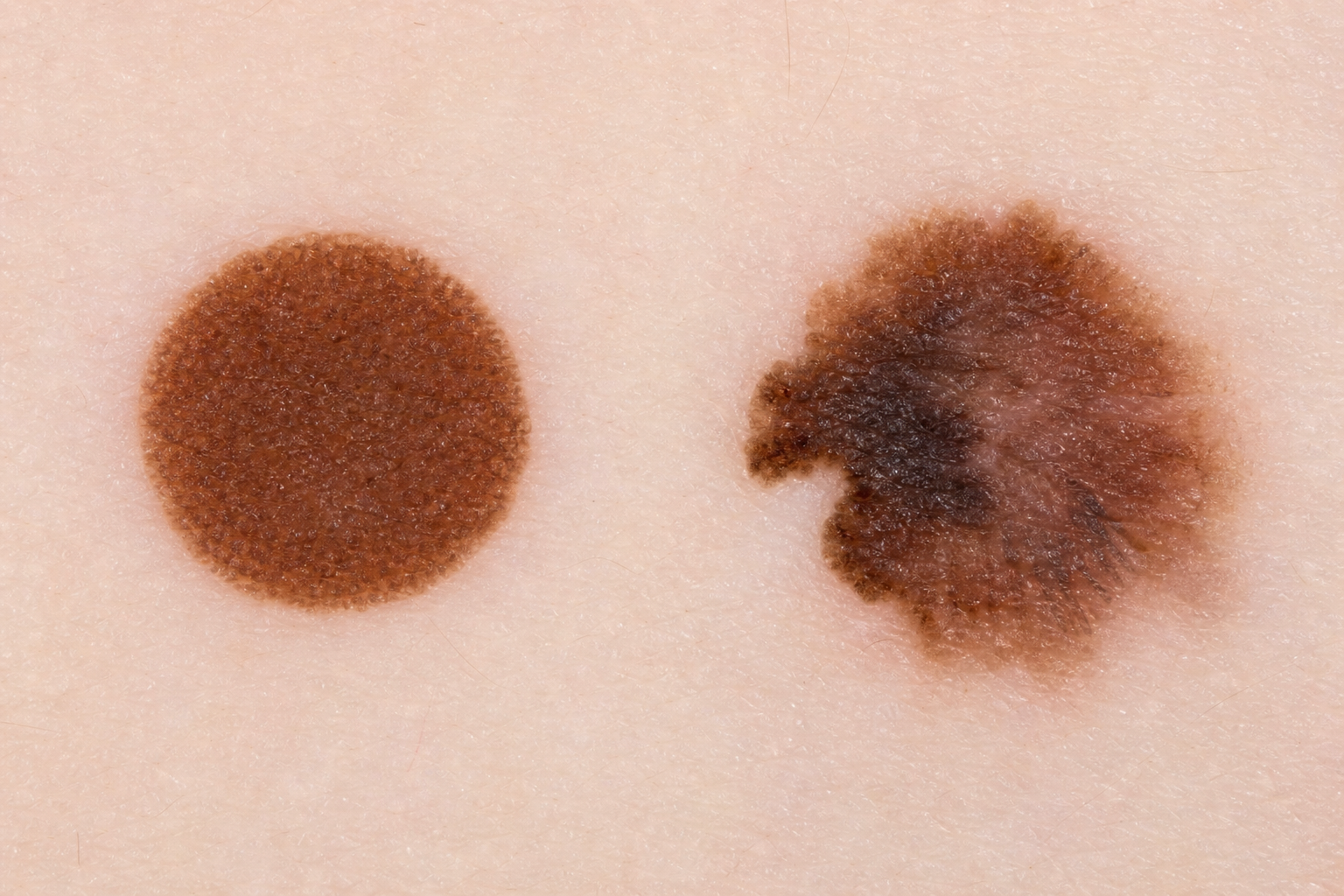 Two moles side by side — left has a clean well-defined circular border; right has a notched, scalloped and partially fading irregular border.