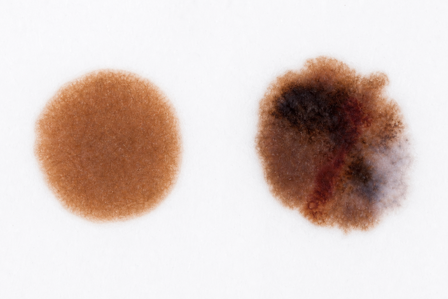Two moles side by side — left is uniform single-shade brown; right contains multiple visible colours including near-black, reddish and pale grey zones.