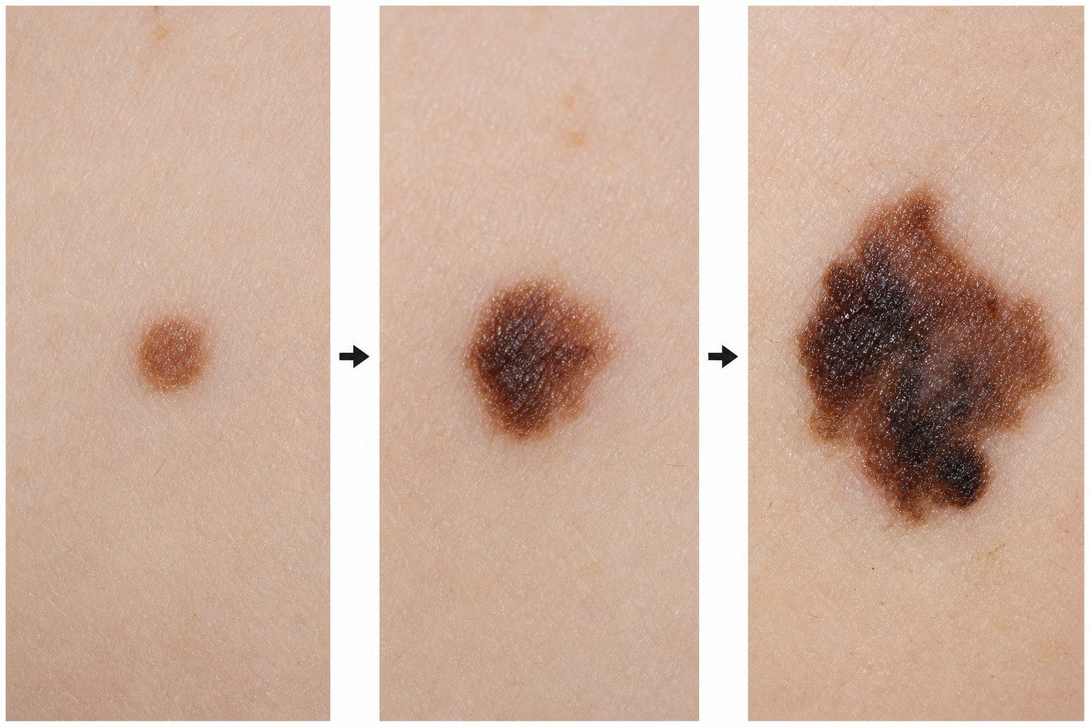 Three sequential close-up photographs of the same mole over time — growing larger, darker and more irregular from left to right.